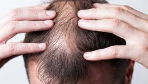 alopecie