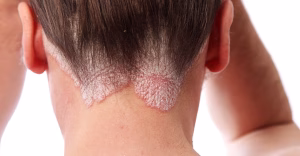 psoriasis