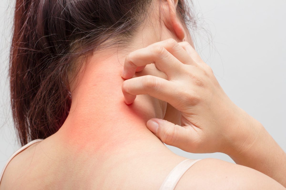 QU’EST-CE QUE LE PSORIASIS ?