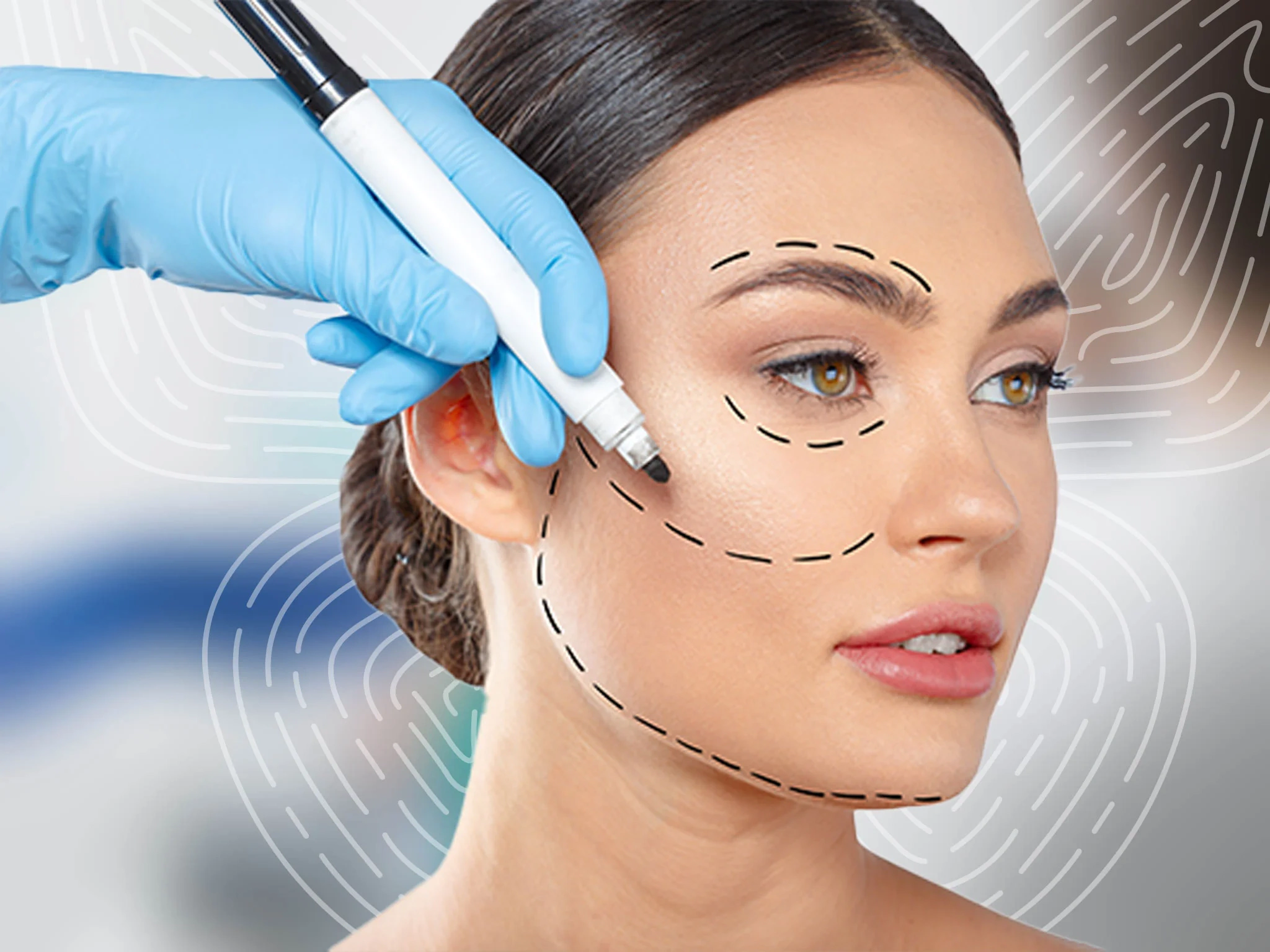 Face-lift